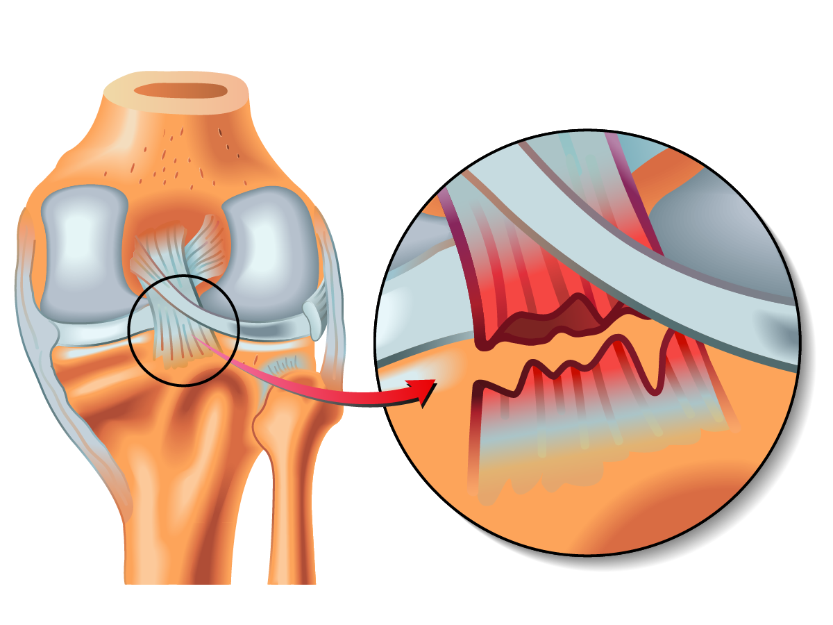 Ligaments croisés postérieurs | Genou trenel